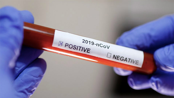 V Česku potvrdili 305 nových prípadov koronavírusu